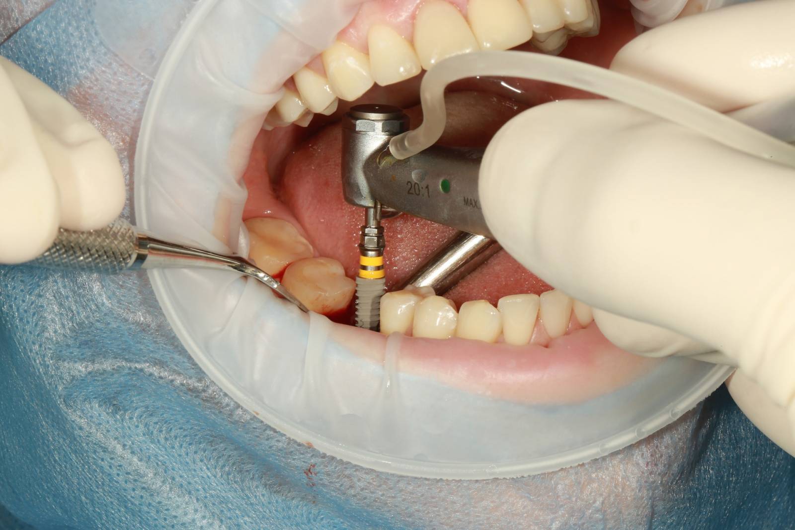 pose d'un implant dentaire à roanne