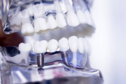 pose de plusieurs implants dentaires à la clinique du Renaison à Roanne
